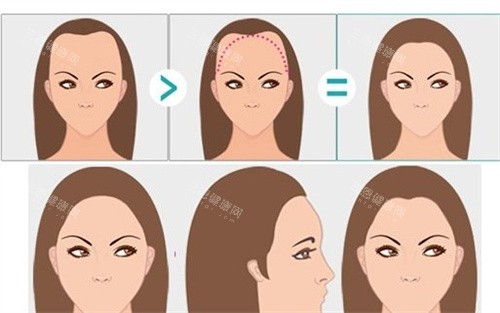 南京蘿愛(ài)美麗再生怎么樣?是植發(fā)實(shí)力機(jī)構(gòu),超微針技術(shù)單價(jià)親民成效直觀